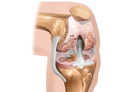 Arthrosis oder Arthritis vun Differenzen