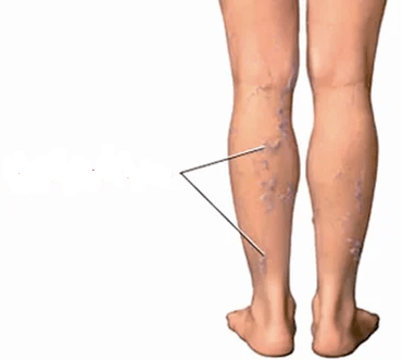 D'Konsequenze vu Knéi Arthrosis