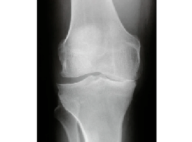 Diagnos vun Arthrosis vum Knéi Gelenk