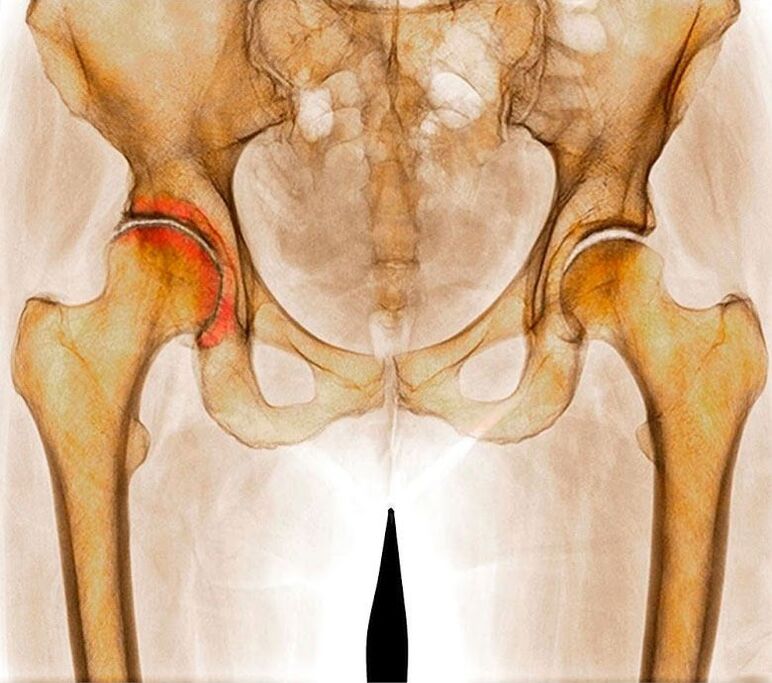 Arthrosis vun der Hip Gelenk