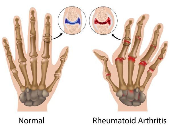 Gelenker vu Fanger ouni Pathologie a mat rheumatoid Arthritis