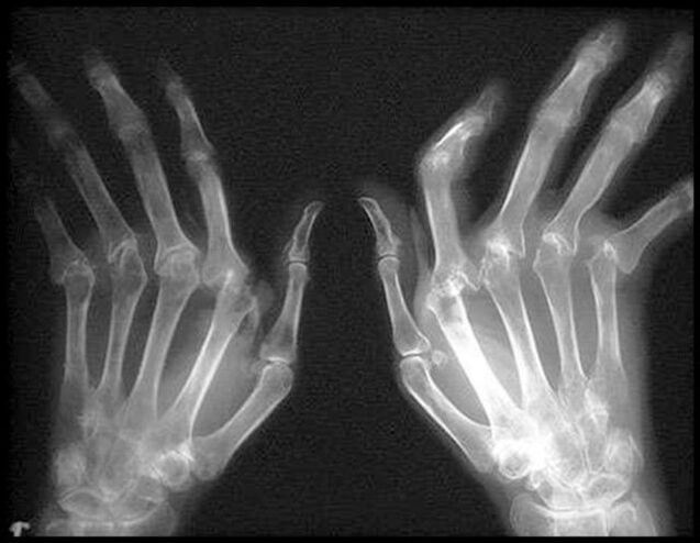 X -ray Bild vun den Hänn betraff vun Arthrosis