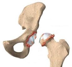 D'Grënn fir d'Entwécklung vu Arthrosis vun der Hüftgelenk