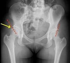 Methode fir d'Behandlung vun Arthrosis vum Hip Gelenk