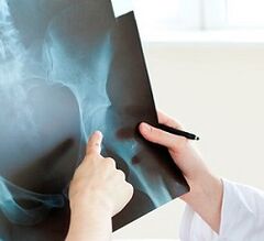 wéi Dir Arthrosis vum Hip Gelenk behandelt