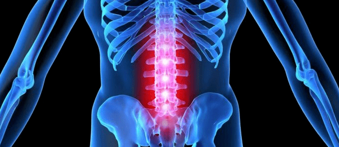 Deformatioun vun der intervertebraler Disc