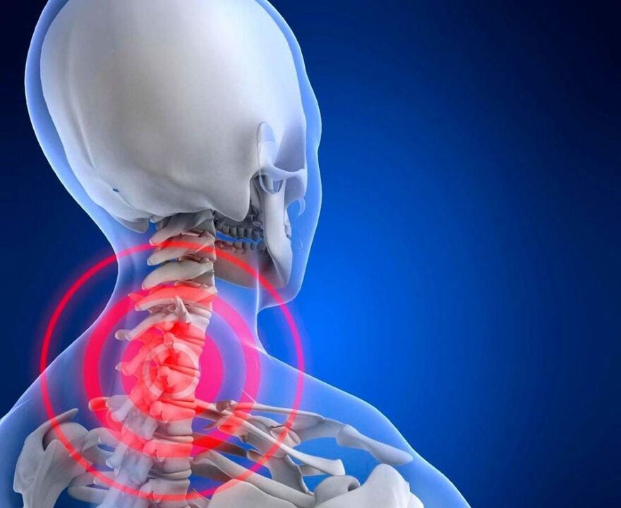 Hals Schmerz mat Gebärmutteral Osteochendrosis