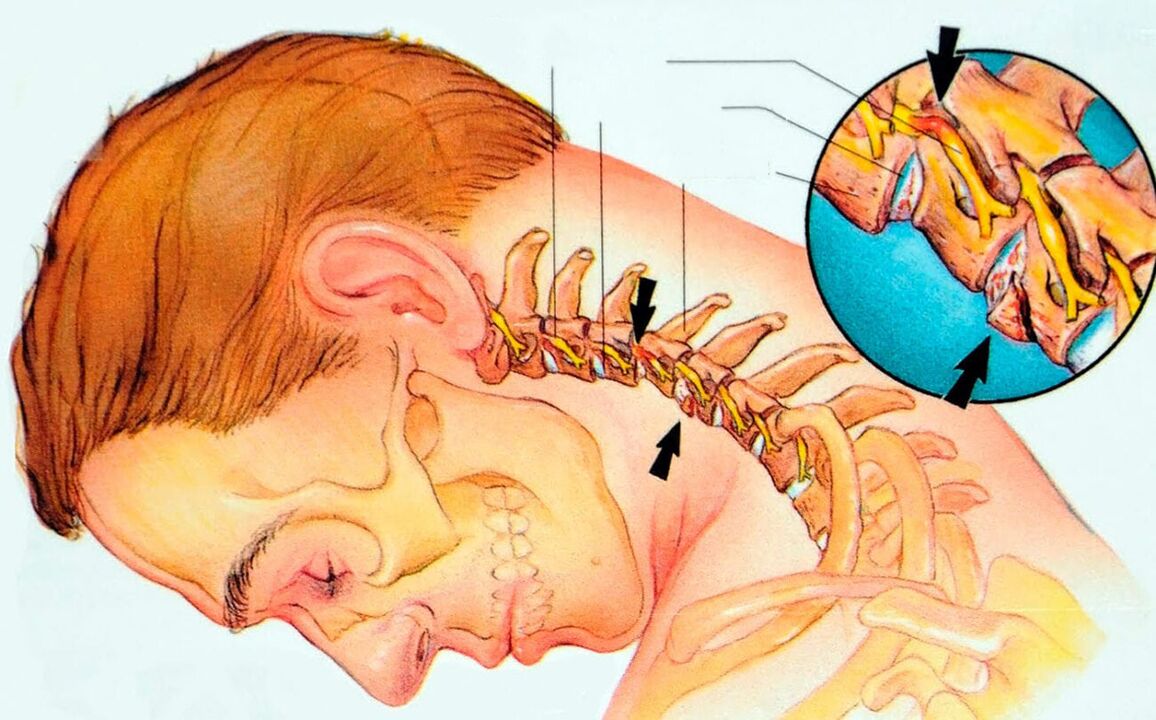 Wat ass cervical Osteochondrosis
