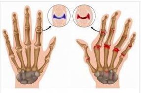 Differenzen tëscht Arthritis an Arthrosis vun den Hänn