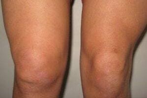 Entzündung am Knéi Gelenk mat Arthritis an Arthrosis