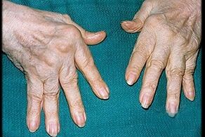 Symptomer vun Arthritis a Fanger