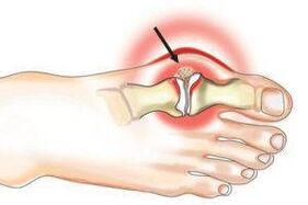gemeinsame Schued wéinst Arthritis an Arthrosis