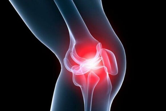 Arthrosis vum Kniegelenk