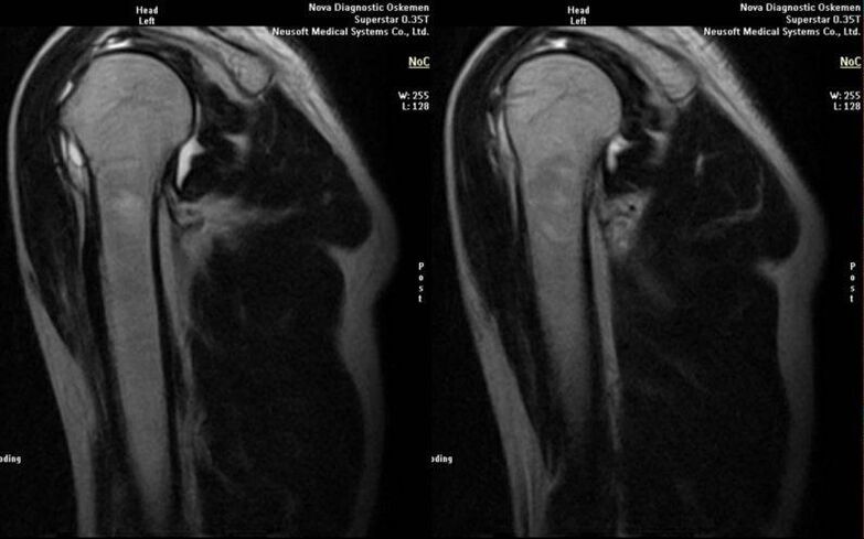 Arthrosis vum Schëllergelenk op Röntgen
