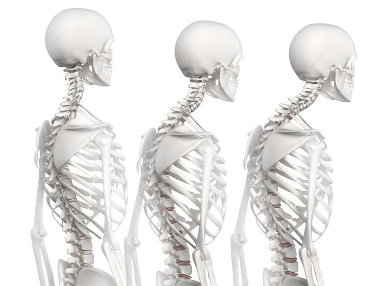 Grad vun der Entwécklung vun der thoracescher Osteochondrose mat dem Beispill vun engem Skelettmodell