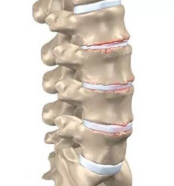 Osteochonds