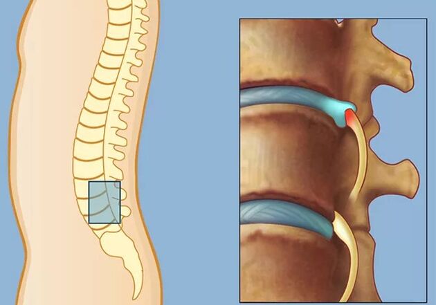 Rook Syndrom